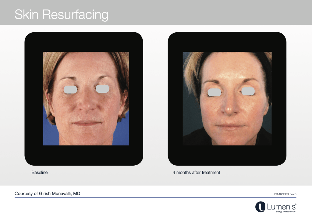 Lumenis UltraPulse® CO2 Fractional Laser Skin Resurfacing Natick, Wellesley  & Weston, MA